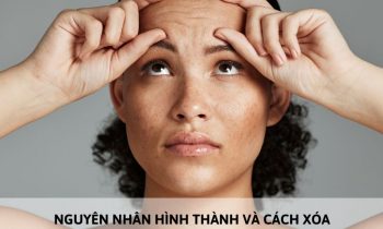 cách xóa nếp nhăn trên trán tại nhà