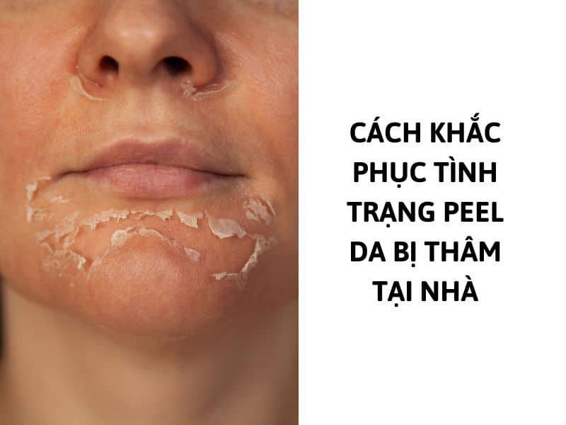 peel da bị thâm